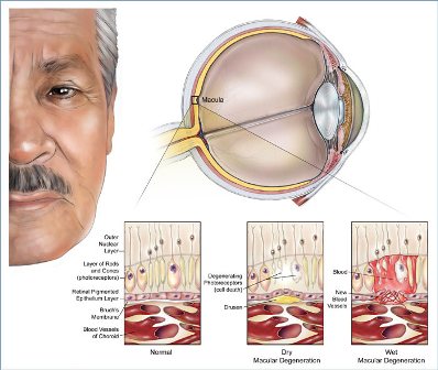 Excess Zinc Could Accelerate Macular Degeneration Global Healthcare Guide Magazine And Consultancy By Dr Prem Jagyasi