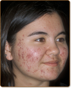 9 Best naturopathic medicines to treat hyper pigmentation acne tc6nt e8qhy