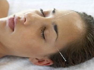 Treat acne the naturopathic way: Natural remedies that really work acupuncture image title tcvw9