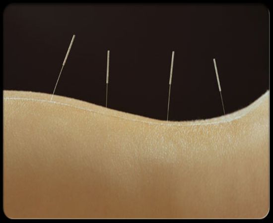 Acupuncture
