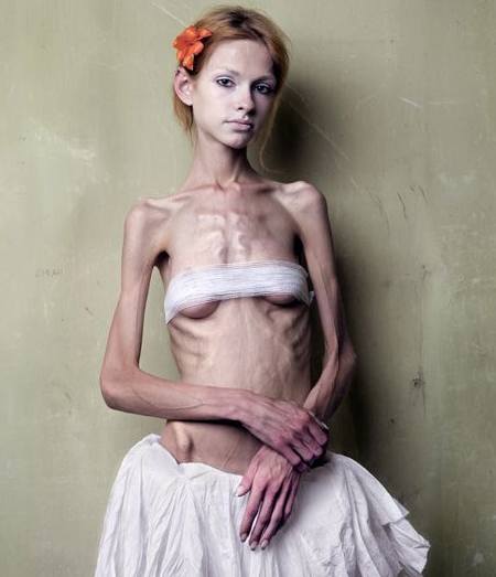 anorexia