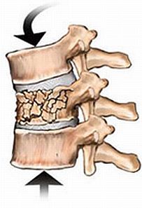 back fracture