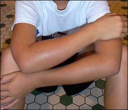 bee sting producing allergic reactions