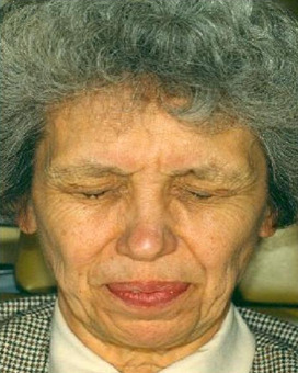 blepharospasm 2112