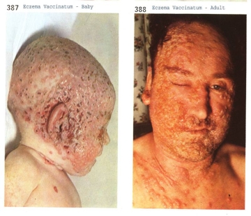 blood chemicals link to eczema