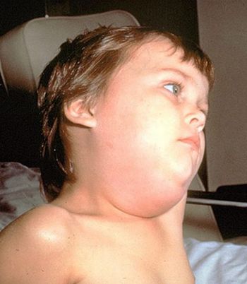 boy with mumps 9 boy with mumps 9