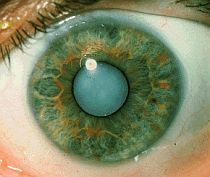 cataract 64