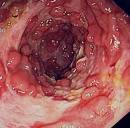 crohns disease 3203