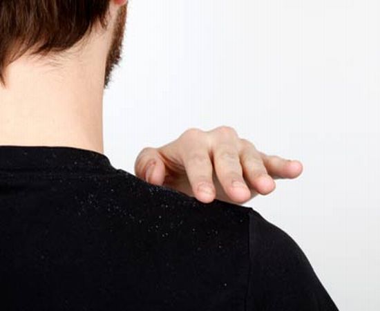 Dandruff: There Is More To Know About It