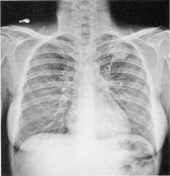 diseased lung