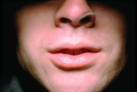 dry mouth