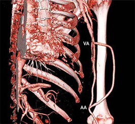 engineered blood vessels engineered blood vessels