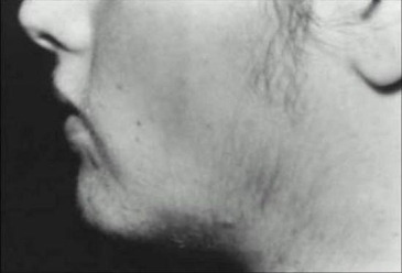facial hirsutism in a 17 year old woman with polyc