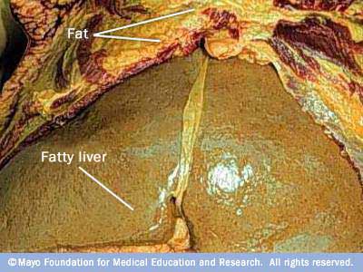 fatty liver