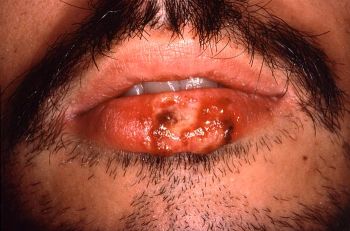 herpes leading to cold sores 9