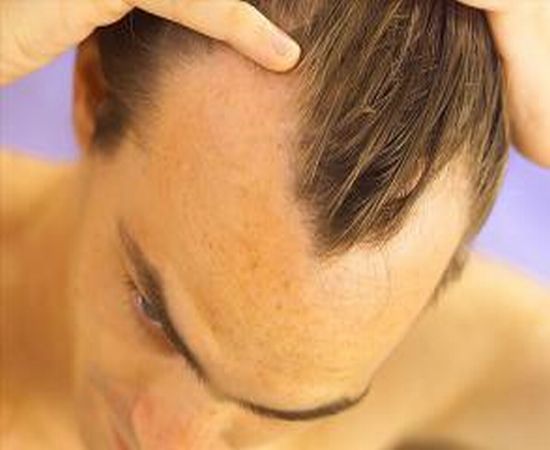 Is Receding Hairline Worrying You?