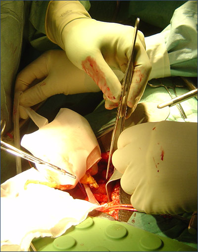 kidney transplant done by doctors
