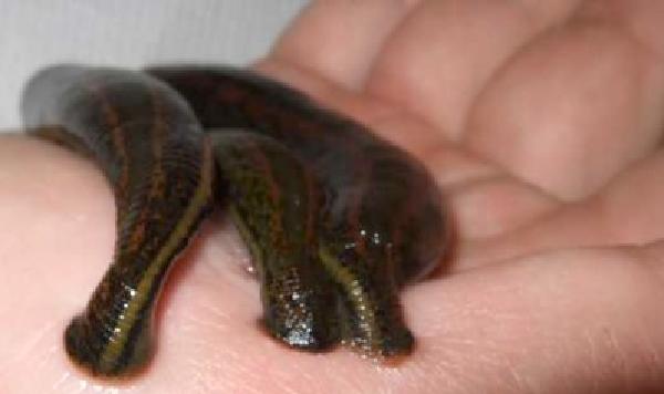 leech therapy