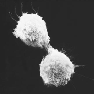lung cancer under microscope