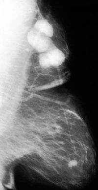 mammogram of breast cancer 9