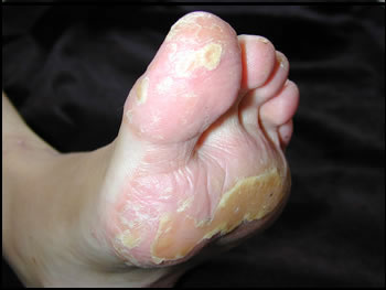 melanoma of foot