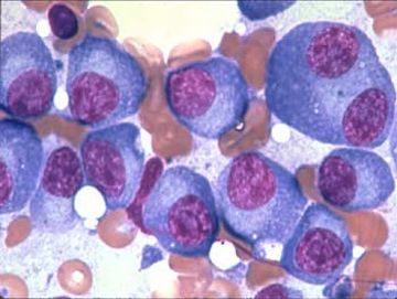 multiple myeloma