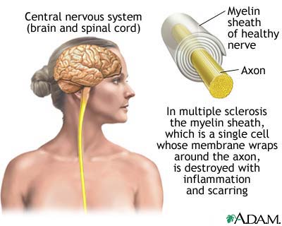 multiple sclerosis