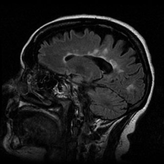 multiplesclerosis1 multiplesclerosis1
