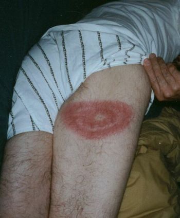 person suffering from lyme disease 9 person suffering from lyme disease 9