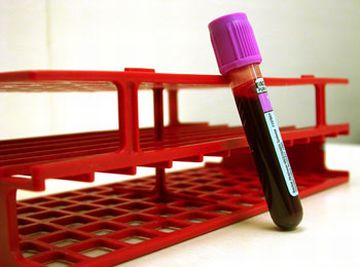 prostate cancer screening method 9