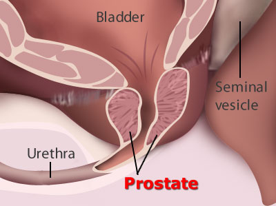 prostate cancer 4767