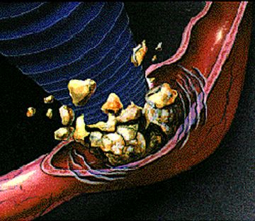 treating kidney stones 9 treating kidney stones 9