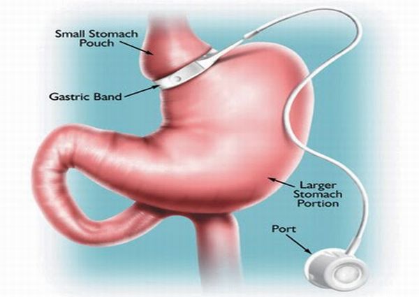 Weight loss surgery