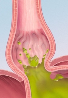 why persistent acid reflux sometimes turns into ca