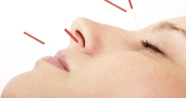 Hold that session: 9 After effects of acupuncture sessions you need to know woman with acupuncture needles in her face rg7 488 d2blj 8i6ce
